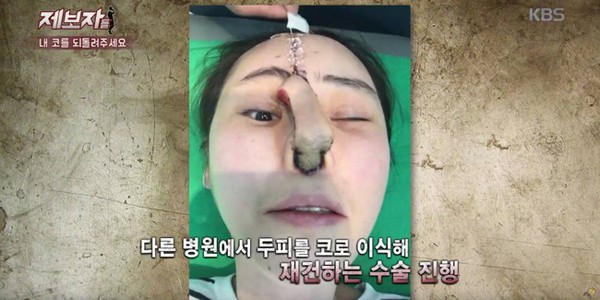 Chiếc mũi của Kim Min Joo gặp biến chứng sau phẫu thuật.