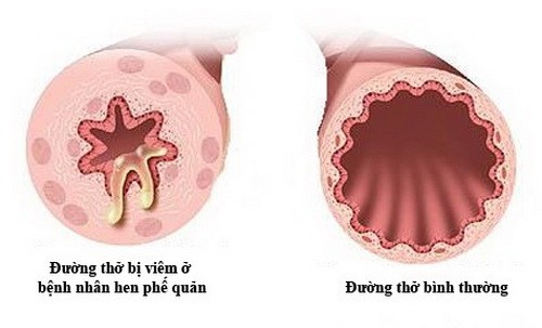 8 cách đơn giản ngừa hen suyễn khi trời rét 1 8-cach-don-gian-ngua-hen-suyen-khi-troi-ret-1