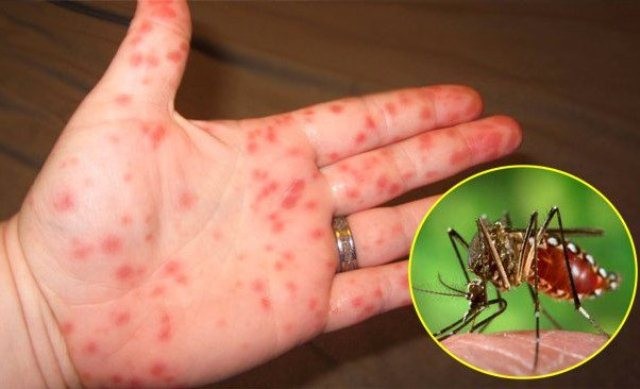 Hà Nội: Bệnh sởi vừa giảm, sốt xuất huyết đã tăng - Nắng nóng mưa nhiều coi chừng mắc bệnh này 1 ha-noi-benh-soi-vua-giam-sot-xuat-huyet-da-tang-nang-nong-mua-nhieu-coi-chung-mac-benh-nay-1