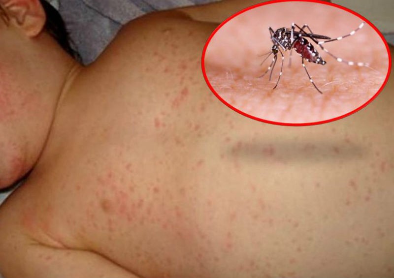 Cảnh báo gia tăng ca bệnh sốt xuất huyết do nắng nóng kéo dài