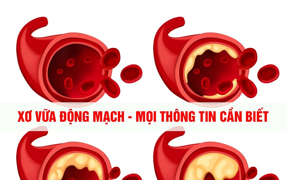 Xơ vữa động mạch - Giải pháp điều trị và phòng tránh biến chứng | Báo Pháp  luật Việt Nam điện tử