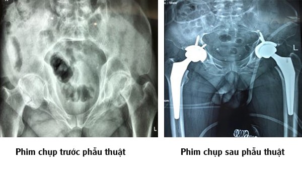 Uống rượu, hút thuốc lá lâu năm người đàn ông gãy 2 bên khớp háng ...