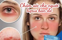 Cách chăm sóc bệnh nhân lupus ban đỏ đơn giản từ Kim Miễn Khang