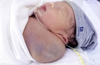 BVĐK Tâm Anh cứu sống bé sơ sinh có khối u nặng bằng 1/3 trọng lượng cơ thể