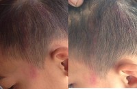 Vết đỏ hằn trên đầu học sinh Đức