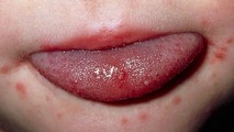 Chuyên gia chỉ cách phân biệt bệnh tay chân miệng với các bệnh khác?