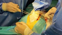 Bệnh viện Tâm Anh giải cứu bệnh nhân thoát khỏi khối u khổng lồ hiếm gặp tại Việt Nam