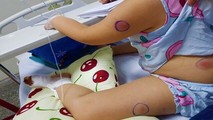 Những vết sưng tấy trên người cháu bé có mầm mống của "vi khuẩn ăn thịt người". (Ảnh: NLĐ).