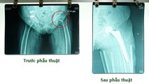 Kết quả chụp phim của bà Q.T.B do té ngã