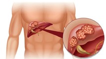 Ở Việt Nam có tới hơn 70% người bệnh phát hiện ung thư gan ở giai đoạn muộn.