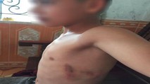 Công an 'vào cuộc' vụ phụ huynh đánh nam sinh lớp 7 tím mạn sườn