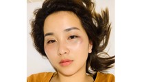 Gương mặt nạn nhân với nhiều vết thâm tím do bị hành hung.