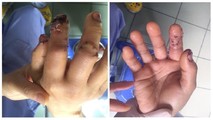 Ngón tay của bệnh nhân kịp thời được bác sĩ phãu thuật thành công.