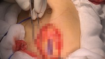 Bé gái vỡ gần hoàn toàn lá lách do đùa giỡn trên bờ ruộng