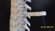 Thanh niên bị dao đâm vào cột sống, mang cả mũi dao vào bệnh viện