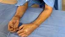 2 bàn tay đứt rời của bệnh nhân đã được các bác sĩ nối lại thành công. Ảnh: BVCC