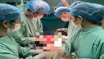 Các Y, Bác sĩ đang phẩu thuật lấy khối u ra khỏi cơ thể bệnh nhân.