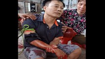 Anh Phi với cánh tay bị thương sau khi bị đối tượng Hài chém.