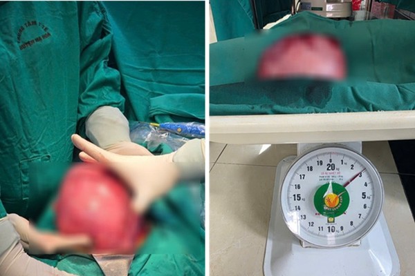 Khối u sơ tử cung của bệnh nhân N nặng gần 3kg.