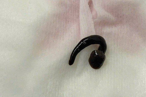 Dị vật là con đỉa suối sống dài khoảng 5cm trong khí quản bệnh nhi 3 tuổi đã được gắp ra. Ảnh: Bệnh viện cung cấp
