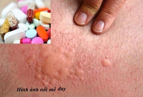 Lưu ý khi dùng thuốc kháng histamin H1 trị dị ứng 1 luu-y-khi-dung-thuoc-khang-histamin-h1-tri-di-ung-1