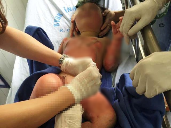 cô giáo mầm non đốt cồn dạy phòng chống cháy nổ khiến 3 trẻ bỏng nặng hình 1 co giao mam non dot con day phong chong chay no khien 3 tre bong nang hinh 1