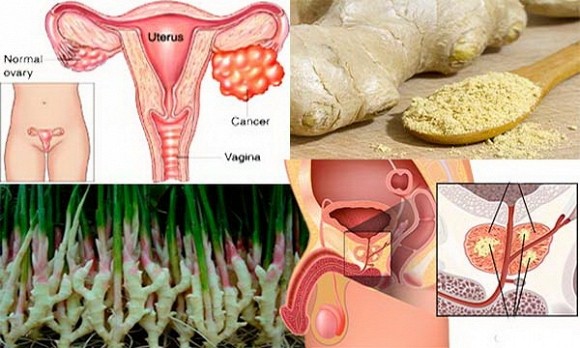 gừng và ung thư 0 gừng và ung thư 0