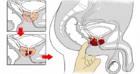 gừng và ung thư 0 gừng và ung thư 0