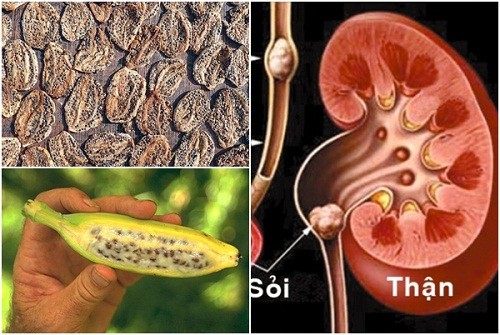 Chuối hột sấy khô chữa viêm loét dạ dày, sỏi thận. Chuối hột sấy khô chữa viêm loét dạ dày, sỏi thận.