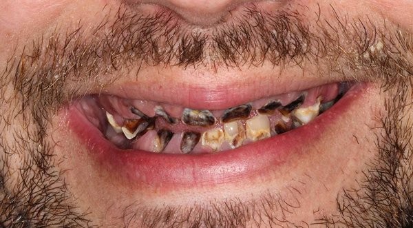 sâu răng,nước ngọt có ga,răng giả sâu răng,nước ngọt có ga,răng giả