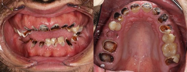sâu răng,nước ngọt có ga,răng giả sâu răng,nước ngọt có ga,răng giả