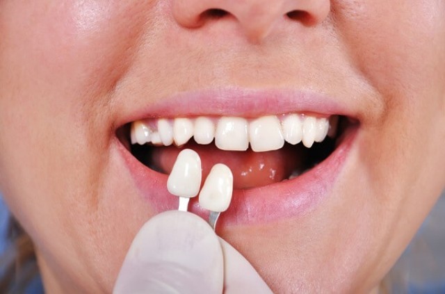 Bác sĩ nha khoa cảnh báo trào lưu gắn răng khểnh tiềm ẩn nhiều độc hại 2 bac-si-nha-khoa-canh-bao-trao-luu-gan-rang-khenh-tiem-an-nhieu-doc-hai-2