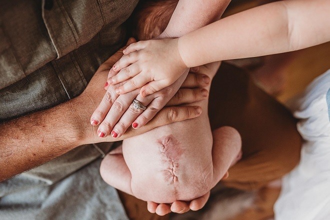 Vết mổ trên lưng Paker khi cậu bé còn trong bụng mẹ (Ảnh: EBU Photography)