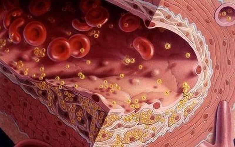 Coi bữa ăn là ăn cơm: Người Việt ngày càng thừa mỡ máu