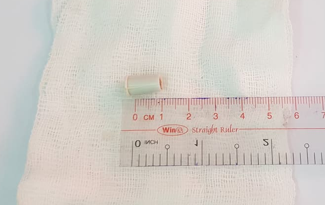 Chiếc lõi kèn nhựa được gắp khỏi đường thở bé trai.