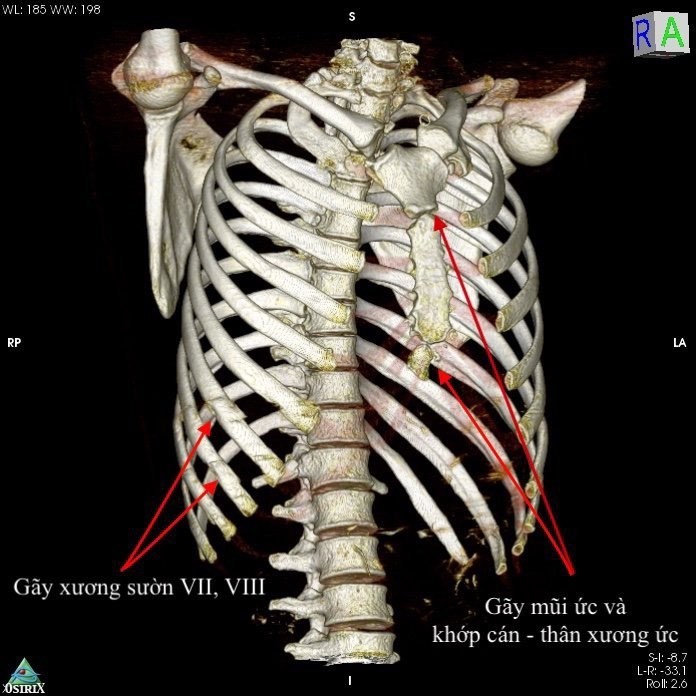 Ngủ gật khi đi xe máy, nam thanh niên Hà Nội bị thủng tim và vỡ gan Ngủ gật khi đi xe máy, nam thanh niên Hà Nội bị thủng tim và vỡ gan