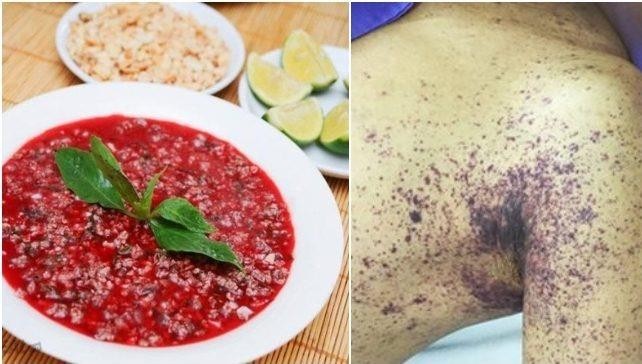 Ăn tiết canh sau hai ngày quý ông tử vong