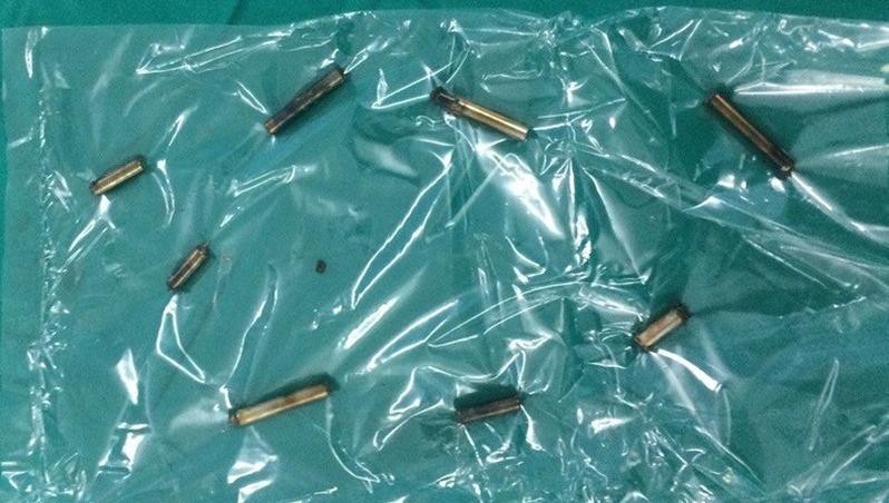 Bé trai 4 tuổi thủng ruột do nuốt 8 thanh nam châm