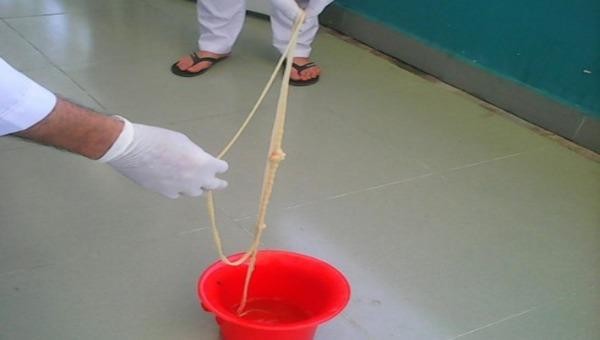 Kinh hãi sán xơ mít dài 7m kí sinh trong cơ thể người đàn ông ở Quảng Nam