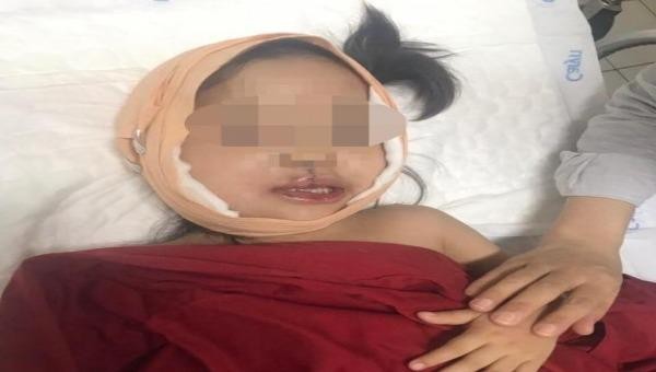 Cắt khối u quái trên mặt nữ bệnh nhi