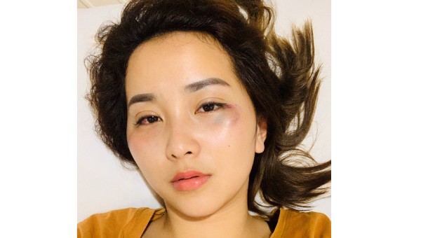 Gương mặt nạn nhân với nhiều vết thâm tím do bị hành hung.