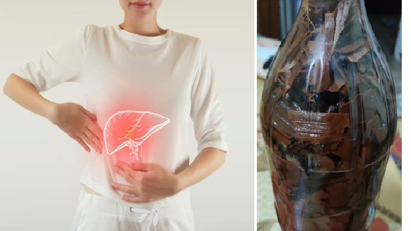 Loại rượu thuốc mà bệnh nhân đã uống dẫn đến tăng men gan.