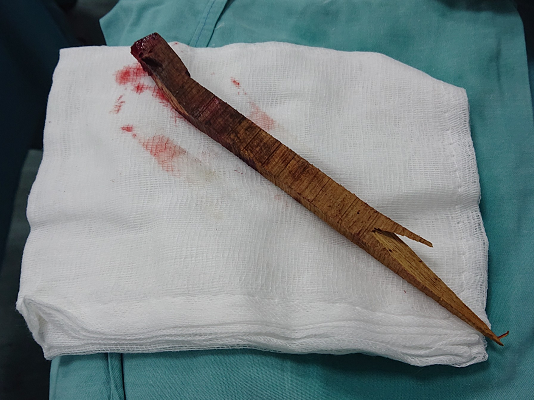 Thanh gỗ được lấy ra khỏi đầu bệnh nhân. Ảnh: BVCC