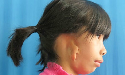 50 trẻ em nghèo dị tật được phẫu thuật miễn phí