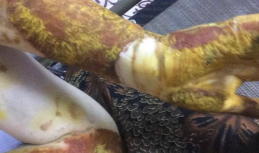Chủ tịch Hà Nội chỉ đạo xử lý nghiêm vụ nữ sinh bị bỏng