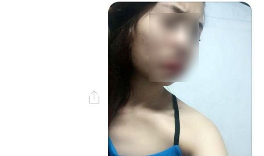 Khuôn mặt biến dạng của chị Lan sau khi phẫu thuật