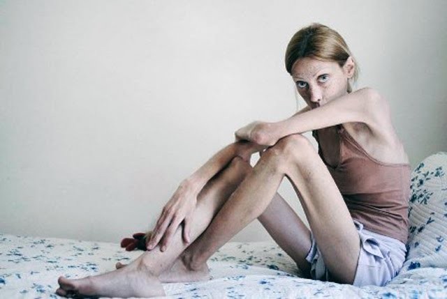 Một nạn nhân của nạn giảm cân