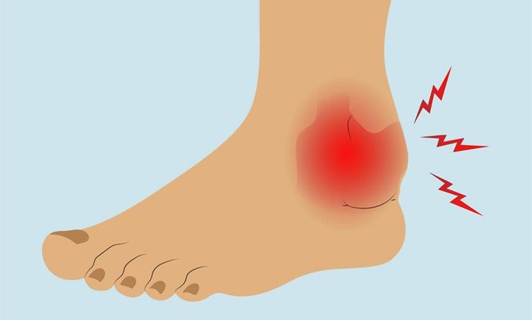 4. Chế độ ăn uống và sinh hoạt phù hợp cho người bị gout