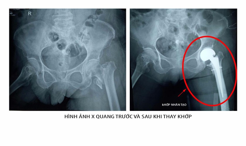 Hình ảnh X – Quang trước và sau khi thay khớp 