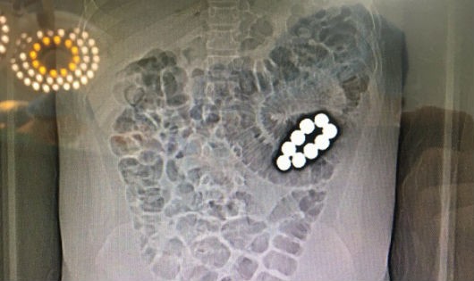 Hình ảnh X-quang trong ổ bụng bệnh nhân. 